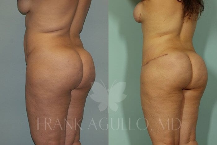 Tummy Tuck Before and After 3