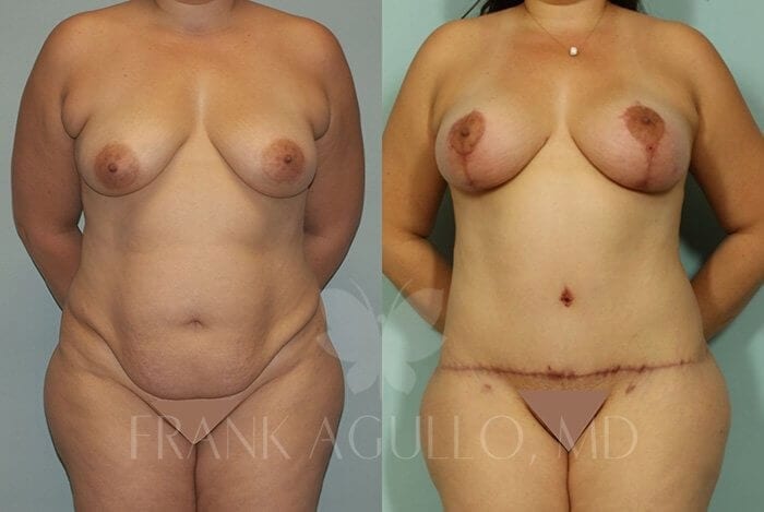 Tummy Tuck Before and After 4