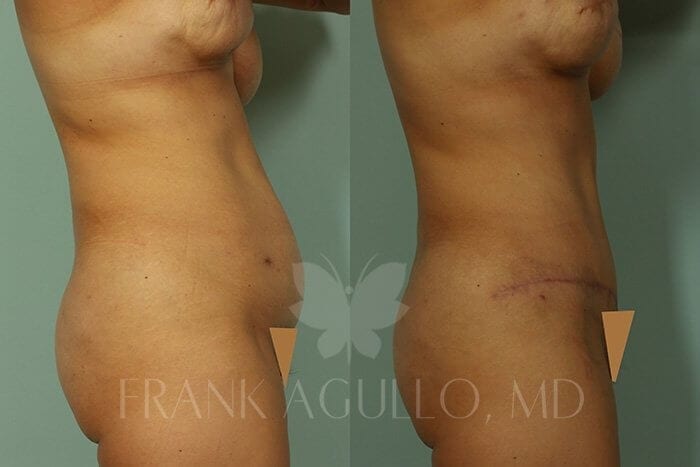 Tummy Tuck Before and After 8