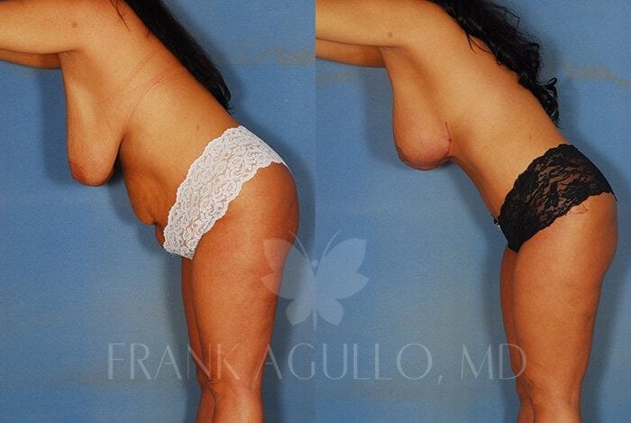 Tummy Tuck Before and After 2
