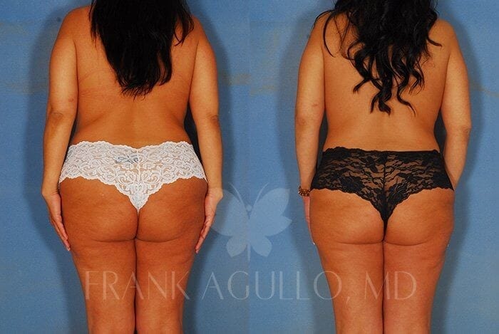 Tummy Tuck Before and After 4
