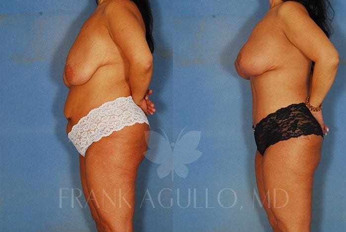 Tummy Tuck Before and After 5