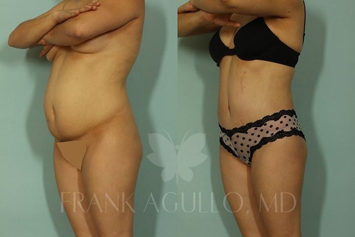 Tummy Tuck Before and After 8
