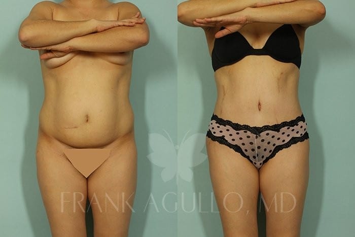 Tummy Tuck Before and After 6