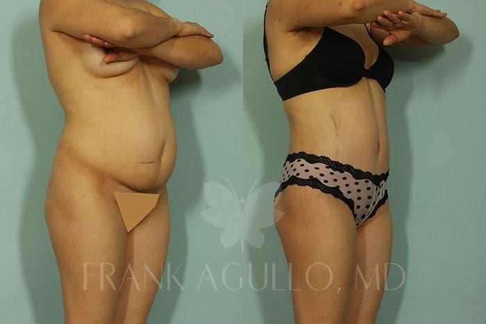 Tummy Tuck Before and After 2