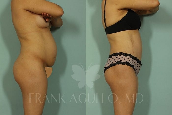 Tummy Tuck Before and After 3
