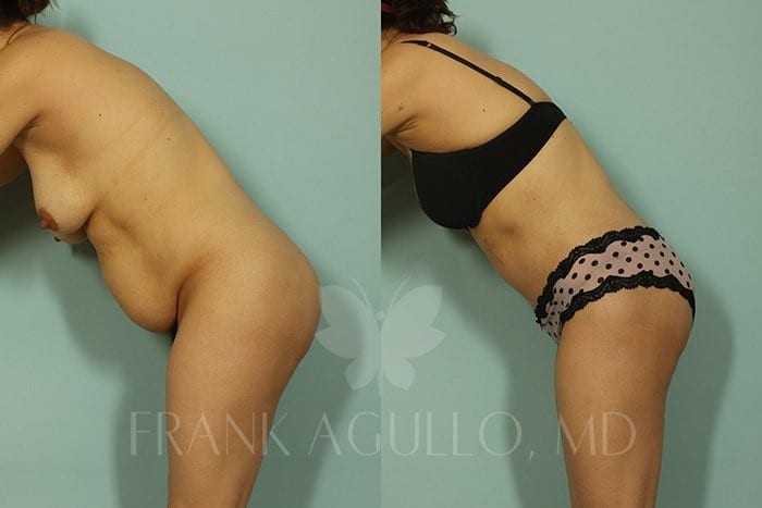 Tummy Tuck Before and After 5