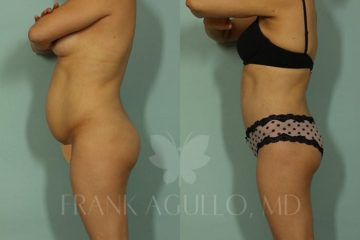 Tummy Tuck Before and After 6
