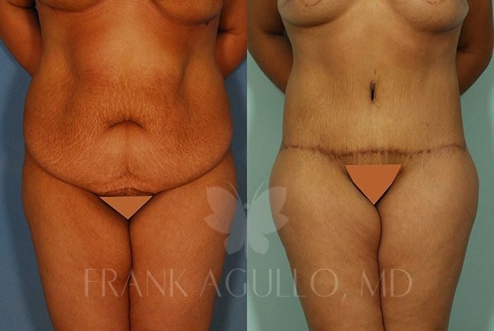 Tummy Tuck Before and After 5