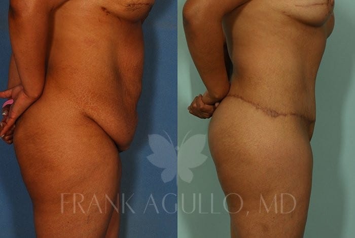 Tummy Tuck Before and After 2