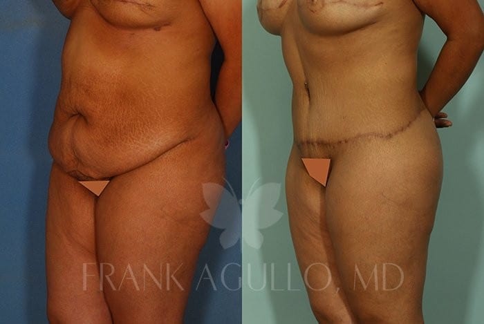 Tummy Tuck Before and After 3
