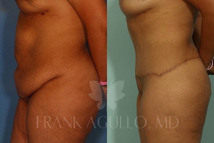 Tummy Tuck Before and After 4