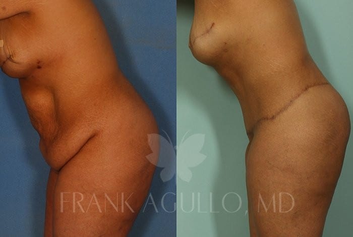 Tummy Tuck Before and After 5